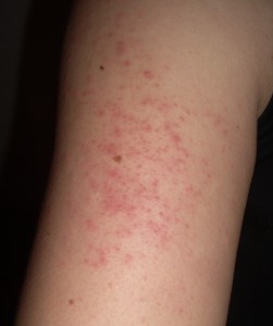 Keratosis pilaris: Röda prickar/knottror på huden på arm.